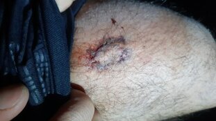 Agent loopt bijtwond op bij aanhouding geweldpleger